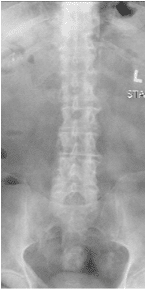 X-rays and MRI of the Lumbar spine showed L4-5 degenerative spondylolisthesis 