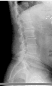X-rays and MRI of the Lumbar spine showed L4-5 degenerative spondylolisthesis 