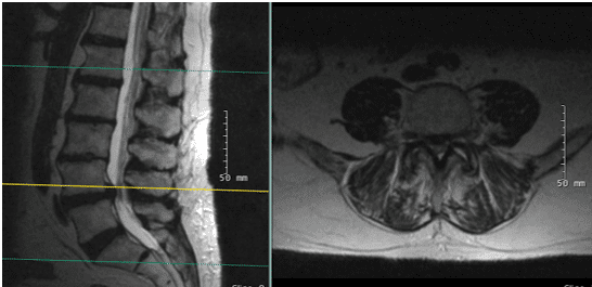 X-rays and MRI of the Lumbar spine showed L4-5 degenerative spondylolisthesis 