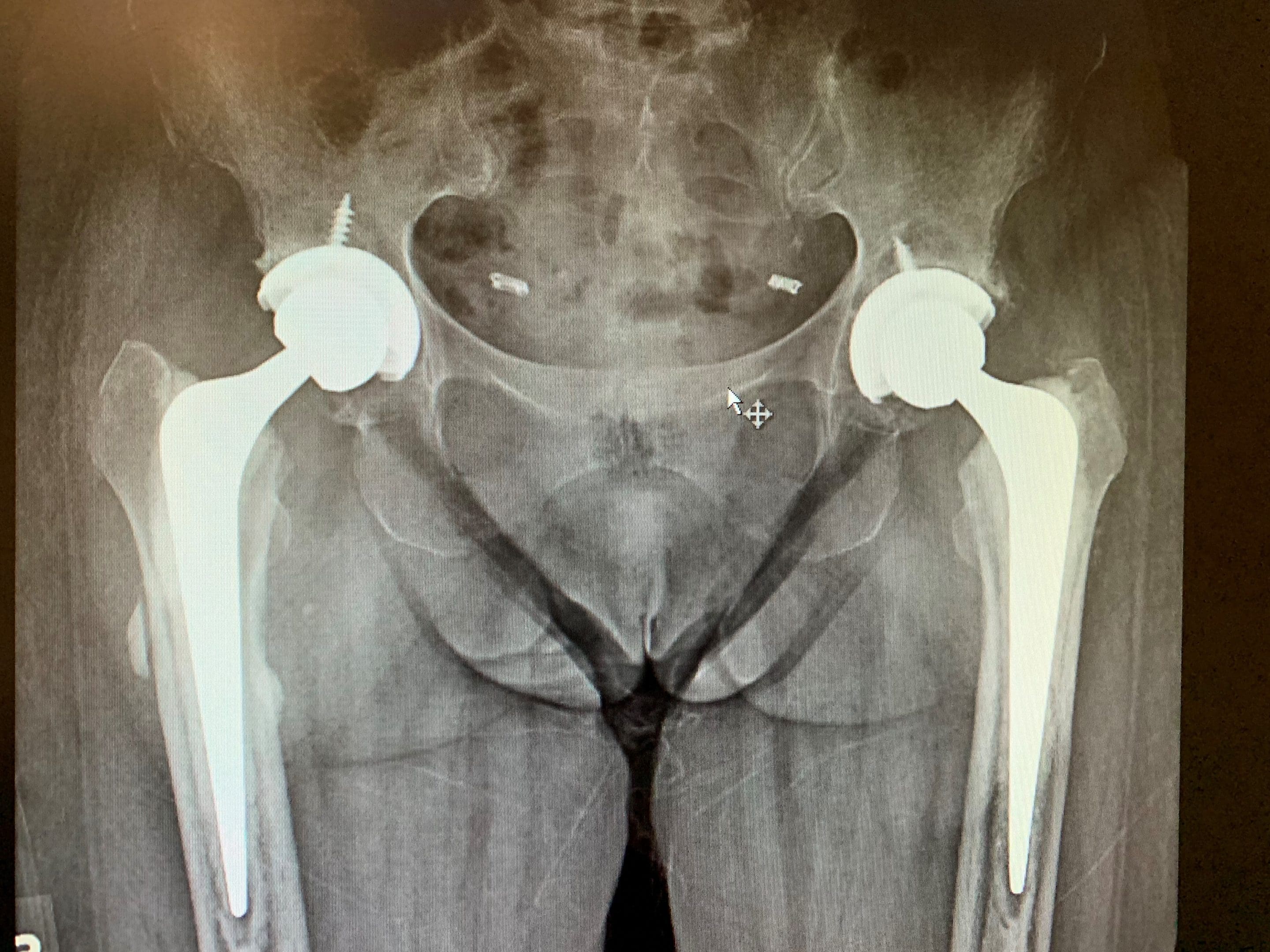 Reemplazo bilateral de cadera en mujer de 66 añosb