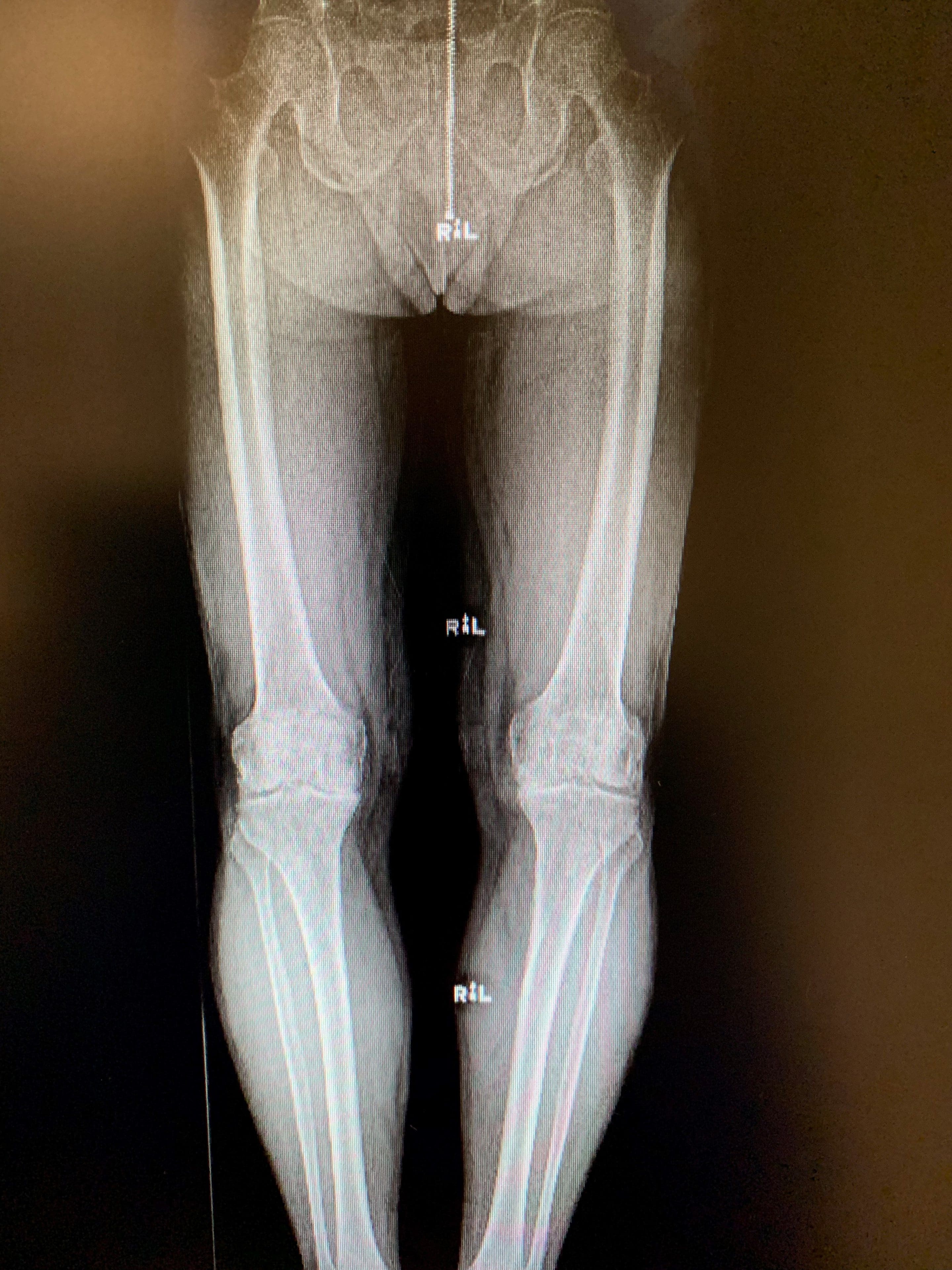 Simultaneous bilateral Unicondylar Knee replacement in 67 year old malea