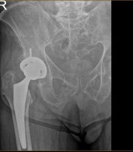 Radiografía de una prótesis de cadera