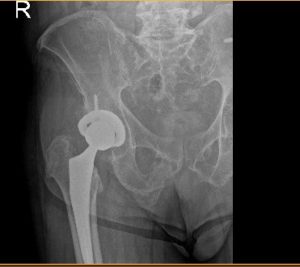 Radiografía postoperatoria de cadera