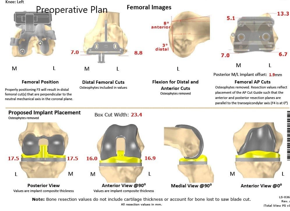 Plan quirúrgico completo específico para paciente de Ortopedia para un reemplazo personalizado de rodilla izquierda en una mujer de 59 años - escaneo 2