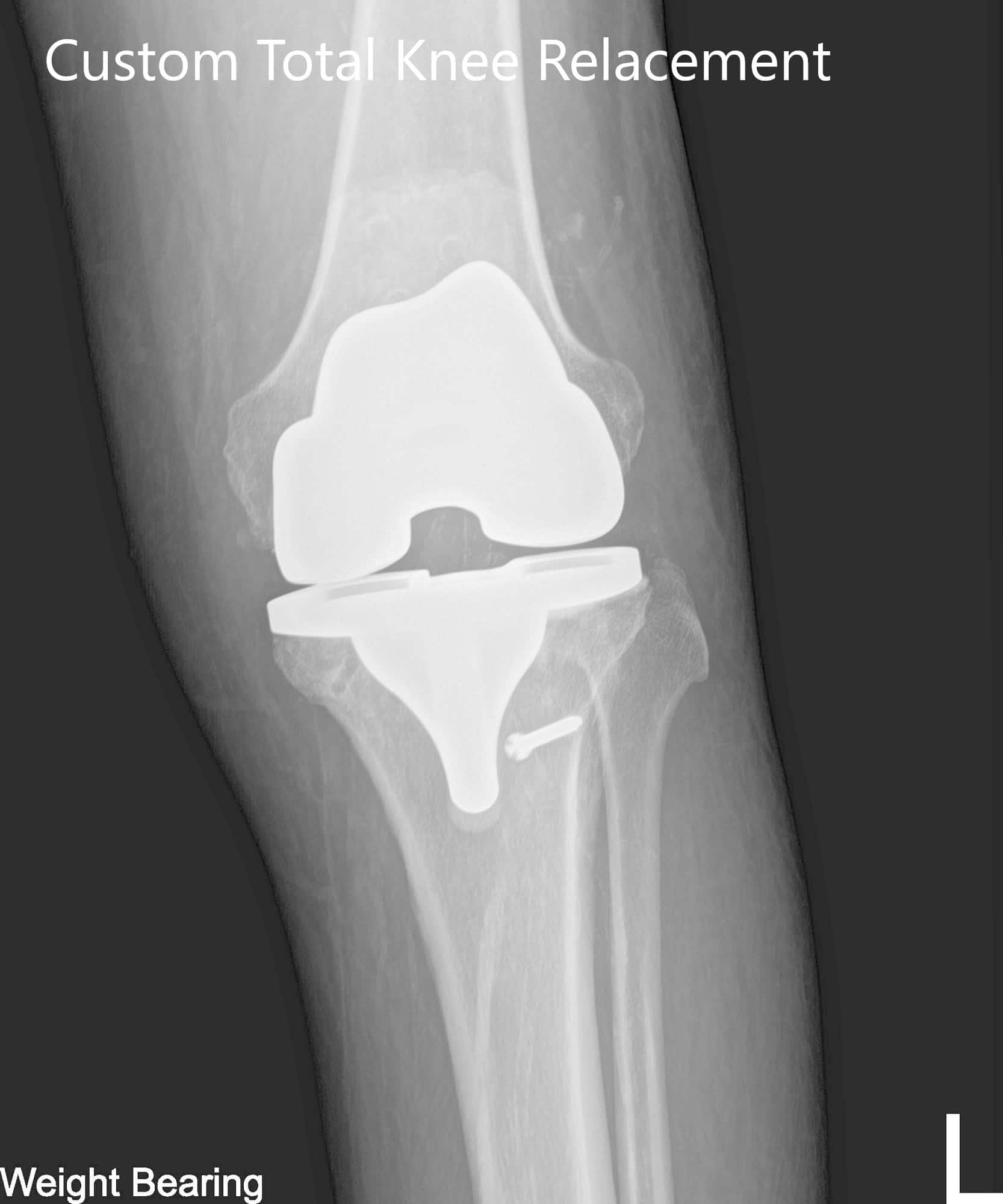 Radiografía postoperatoria de la rodilla izquierda que mostró visión AP y lateral
