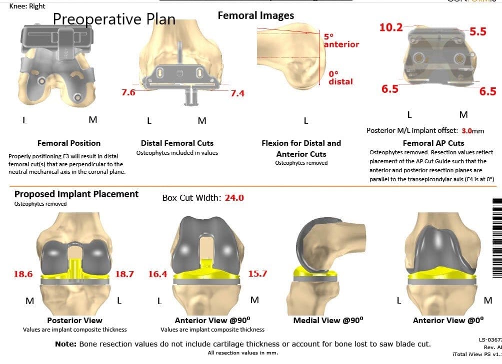 Plan quirúrgico completo de ortopedia específico para un reemplazo unilateral de rodilla personalizado en una mujer de 74 años - ecografía 2
