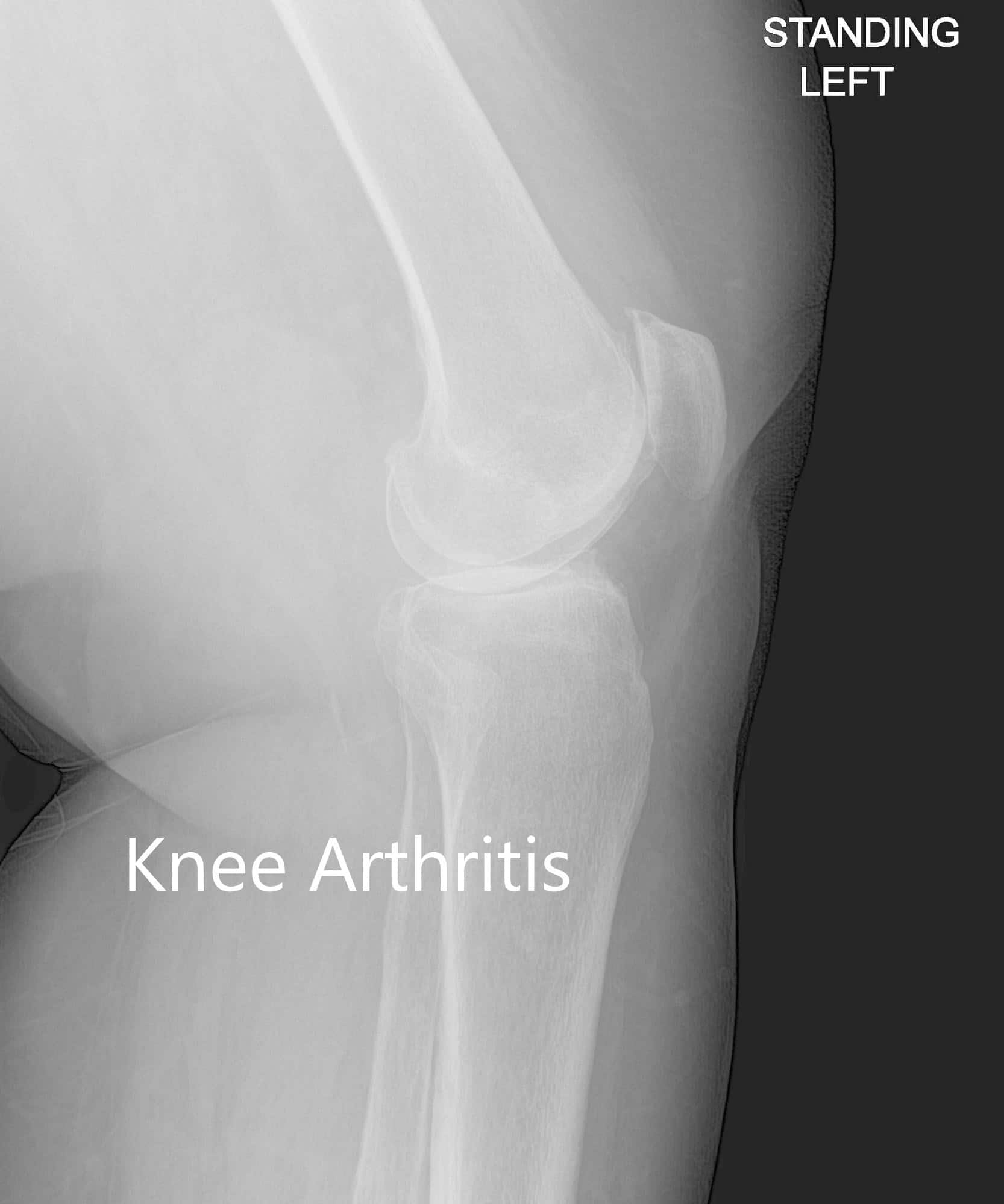 Vista anteroposterior y lateral de la rodilla izquierda - img 2