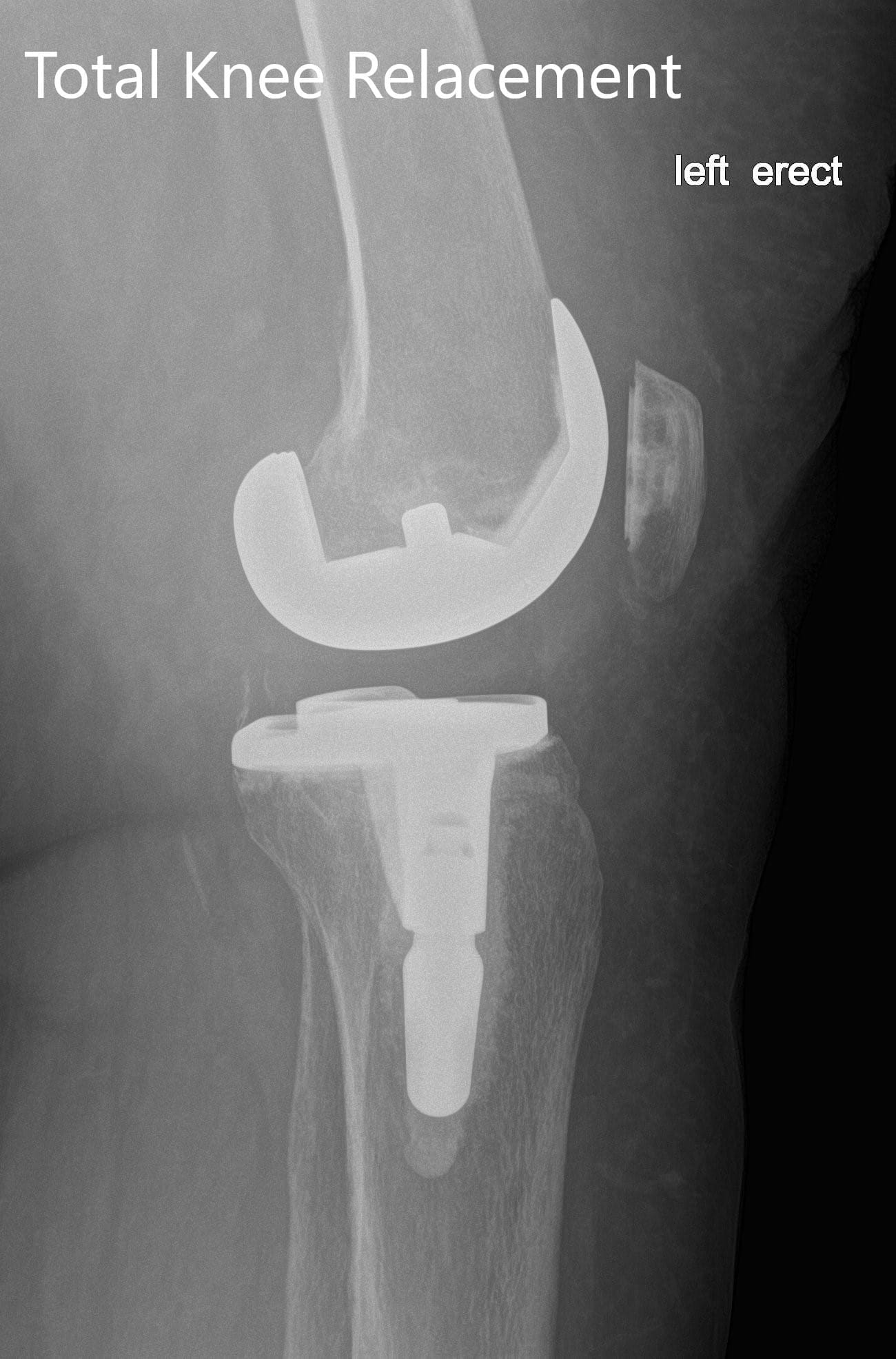 Radiografía postoperatoria de la izquierda mostrando la vista anteroposterior y lateral con prótesis total de rodilla en posición