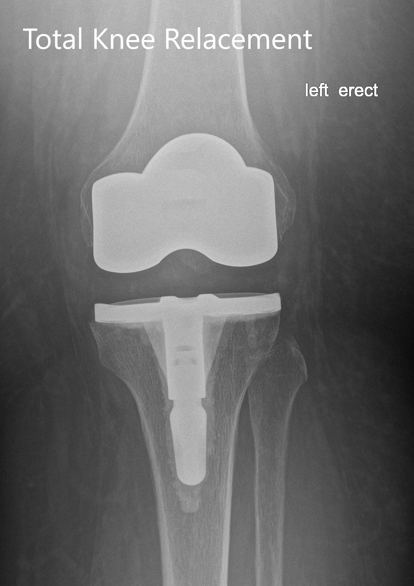 Radiografía postoperatoria de la izquierda mostrando la vista anteroposterior y lateral con prótesis total de rodilla en posición - img 2