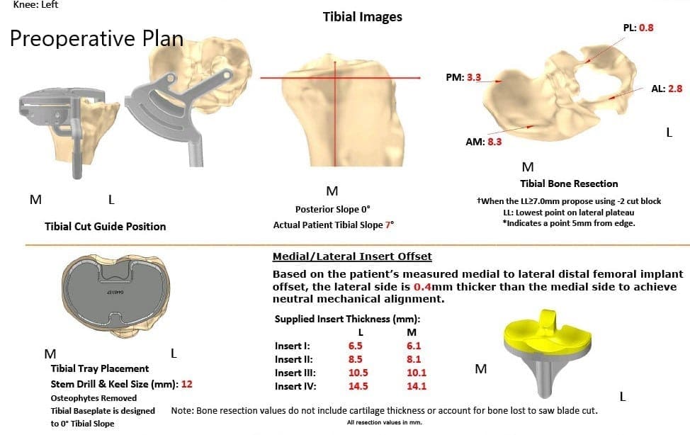Plan quirúrgico completo específico para pacientes en ortopedia para un reemplazo total personalizado de rodilla en artritis de rodilla izquierda con hardware previo en la meseta tibial lateral