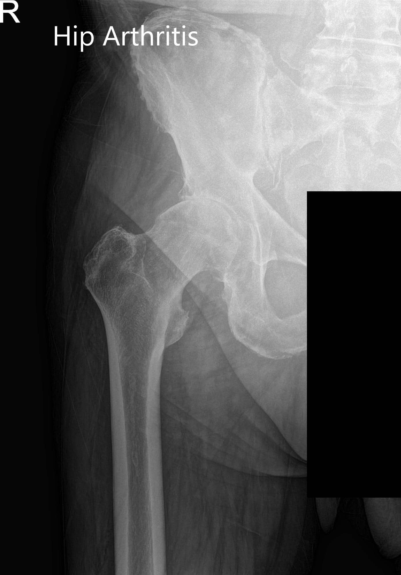 Imágenes de rayos X preoperatorias que muestran la visión lateral de la pata de rana de la cadera derecha - img 2
