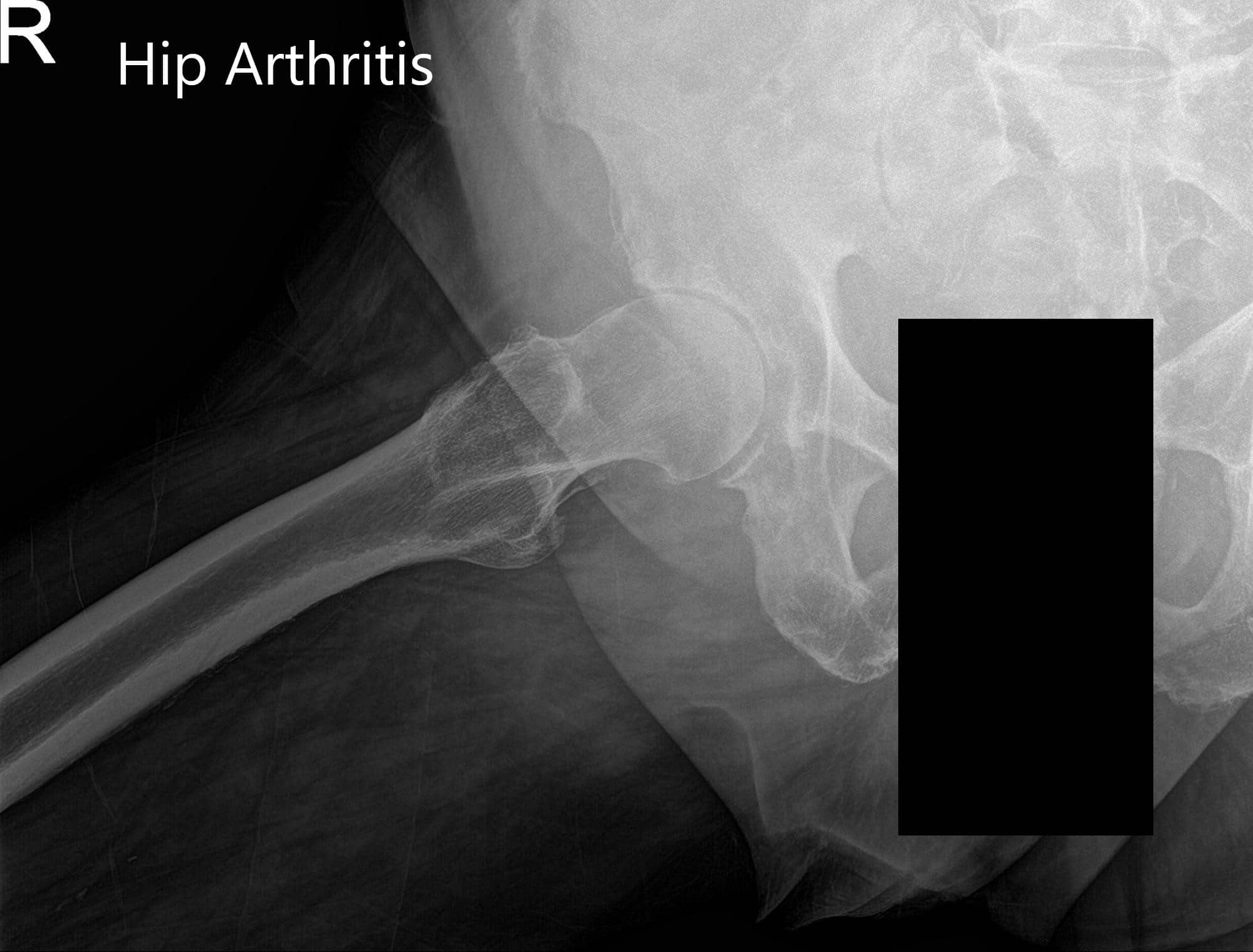 Imágenes de rayos X preoperatorias que muestran la visión lateral de la pata de rana de la cadera derecha - img 2