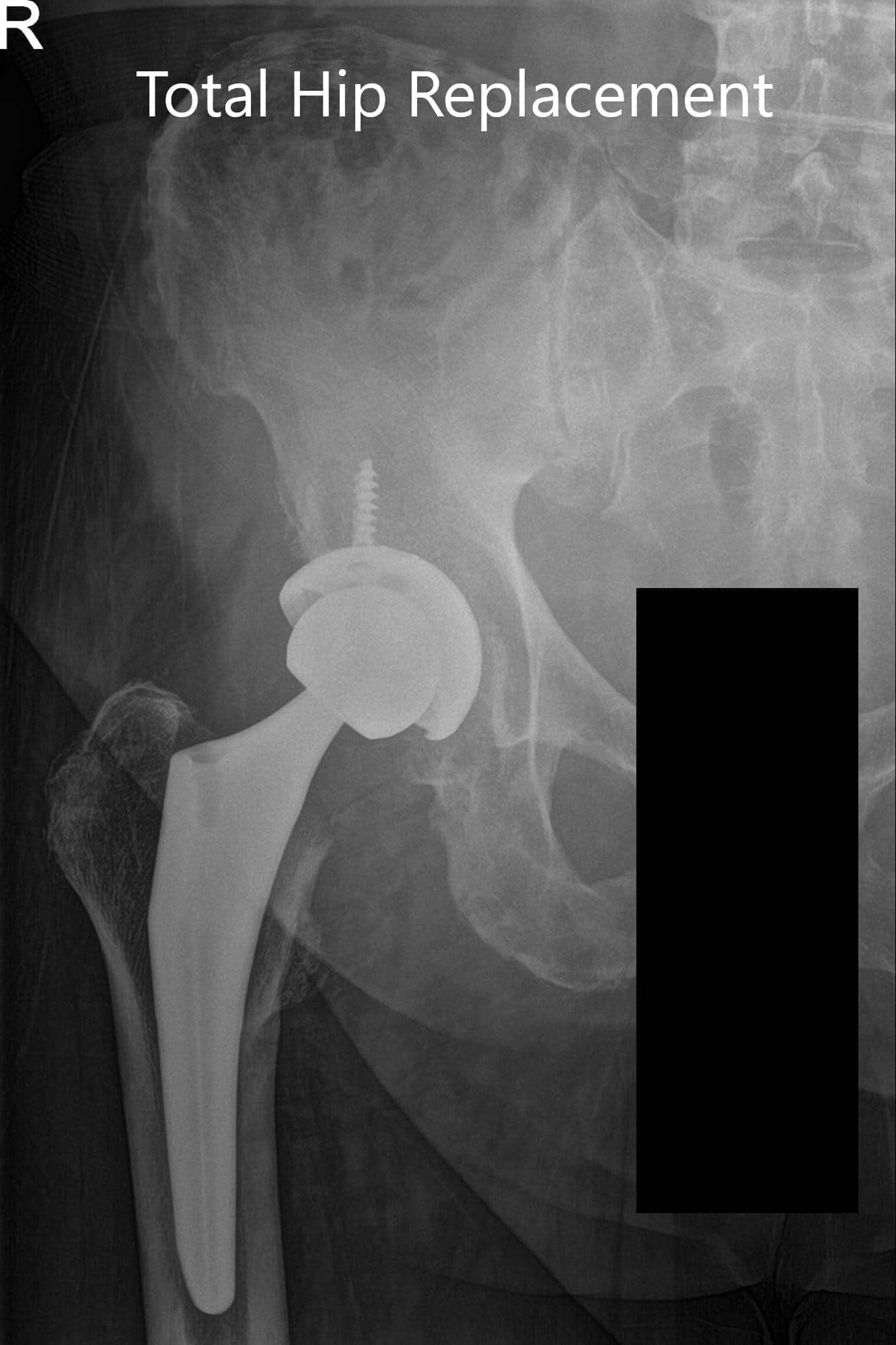 Radiografía postoperatoria que muestra vistas laterales de la cadera derecha y de la pata de rana