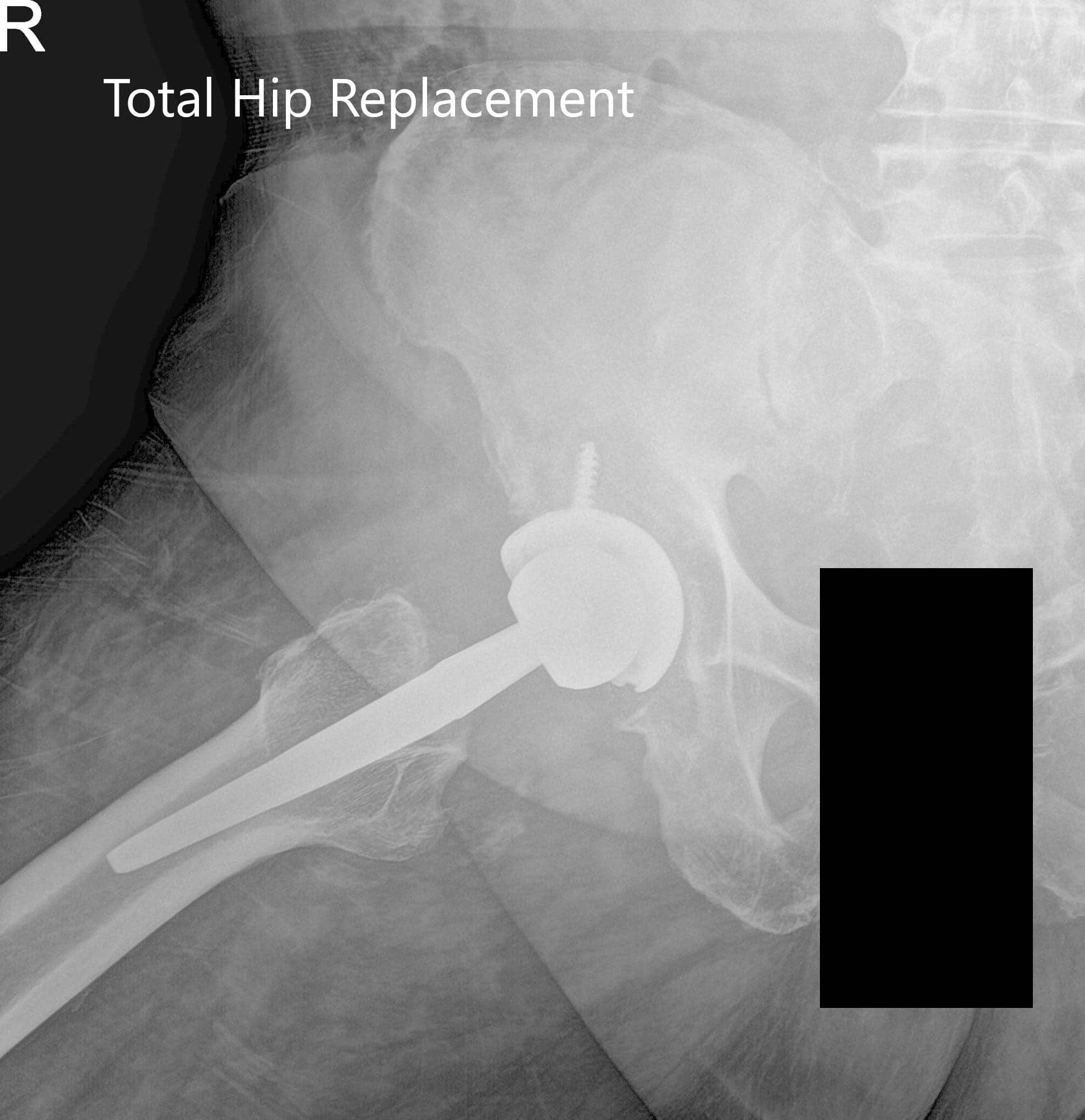 Radiografía postoperatoria que muestra visiones laterales de la pata de rana y la pata de rana de la cadera derecha - img 2