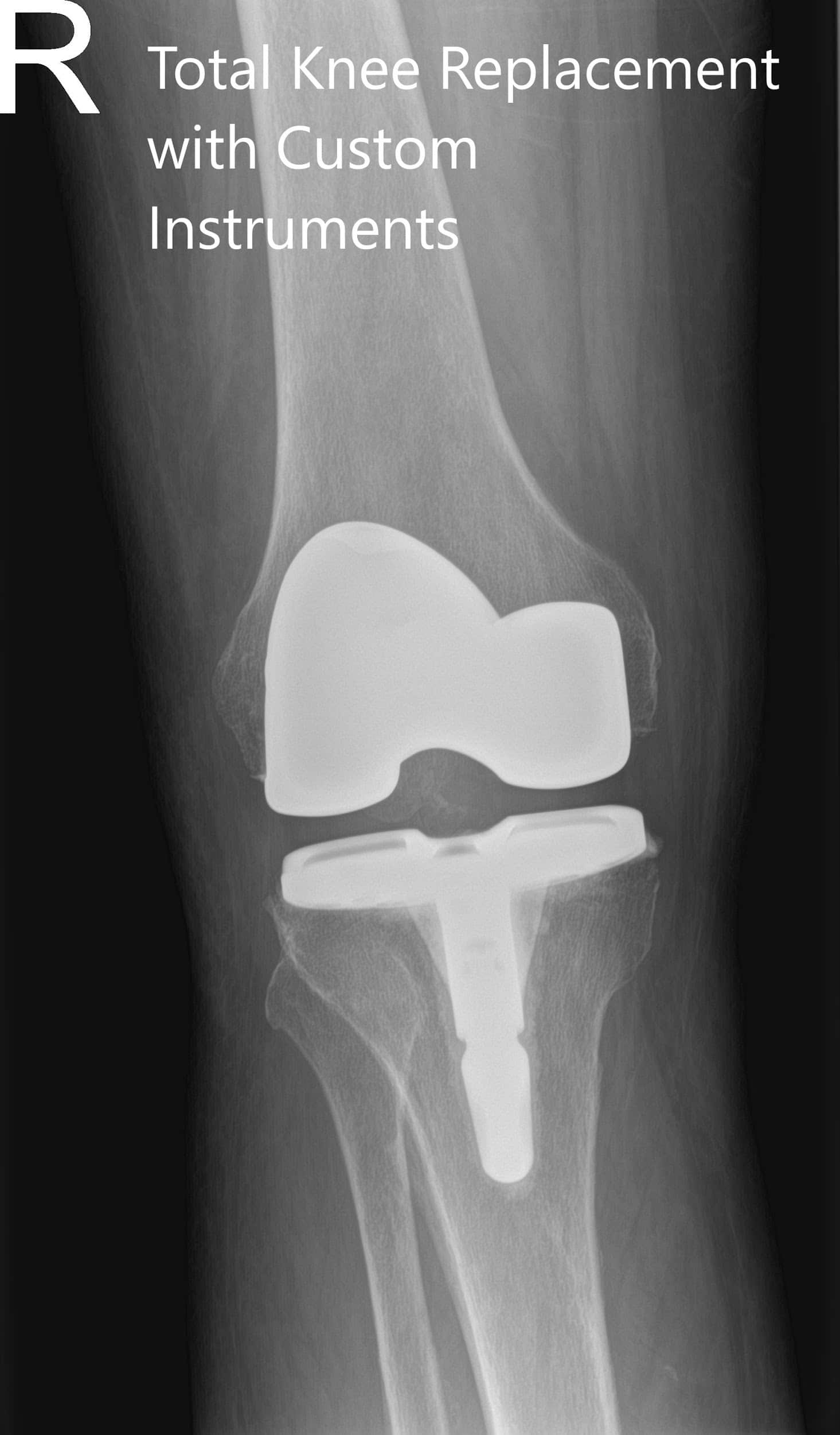 radiografía ostoperatoria de la rodilla derecha en vistas anteroposterior y lateral