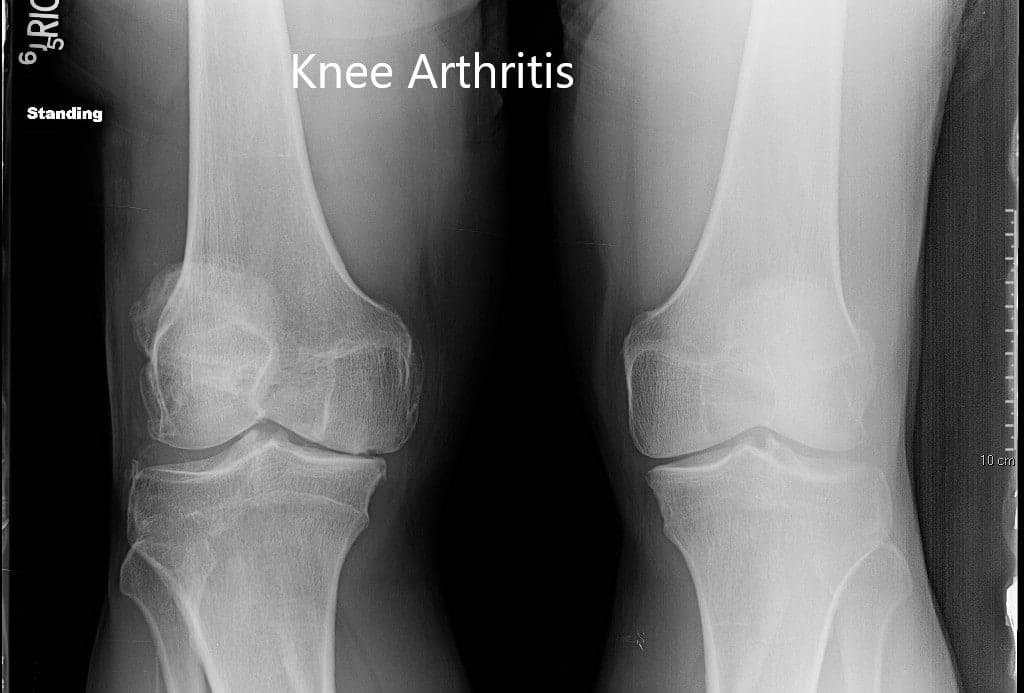 Radiografía preoperatoria de ambas rodillas en vista anteroposterior Radiografía preoperatoria de ambas rodillas en vista anteroposterior