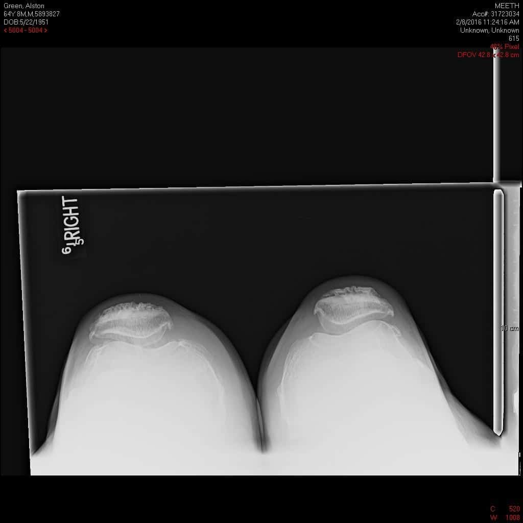 Radiografía preoperatoria de la rodilla derecha en vista lateral y vista del horizonte - IMG 2 Radiografía preoperatoria de la rodilla derecha en vista lateral y vista del horizonte - IMG 2