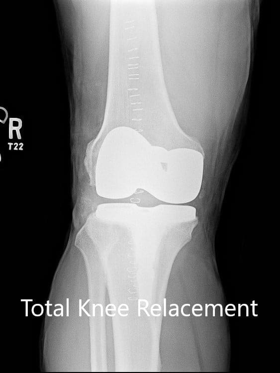 Radiografía postoperatoria de la rodilla derecha con prótesis en vistas anteroposterior y lateral Radiografía postoperatoria de la rodilla derecha con prótesis en vistas anteroposterior y lateral