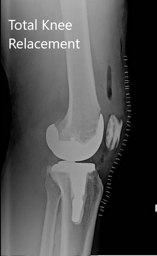 Radiografía postoperatoria de la rodilla derecha con prótesis en las vistas anteroposterior y lateral - img 2 Radiografía postoperatoria de la rodilla derecha con prótesis en las vistas anteroposterior y lateral - img 2