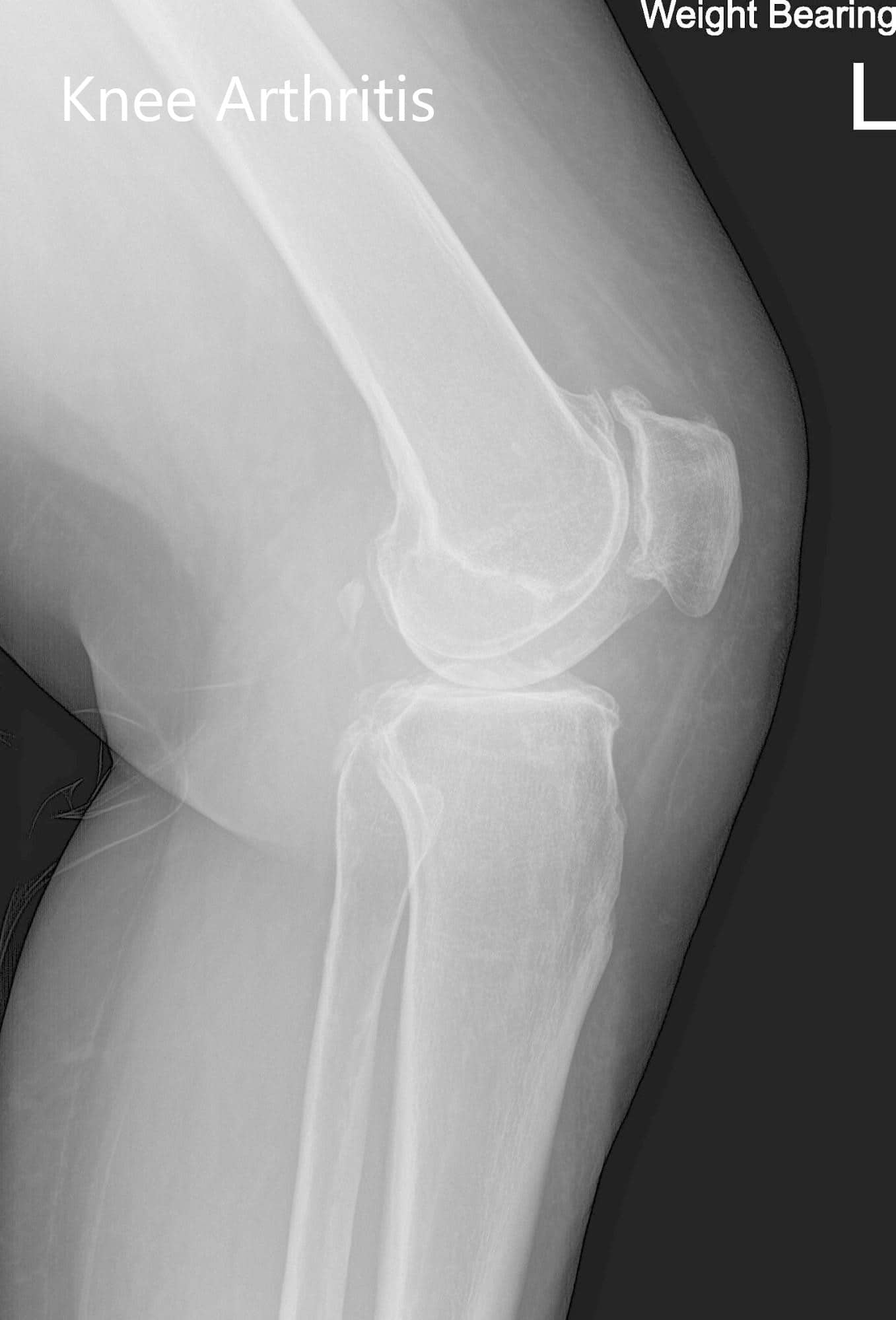 Radiografía preoperatoria de la rodilla izquierda que mostró vistas AP y laterales