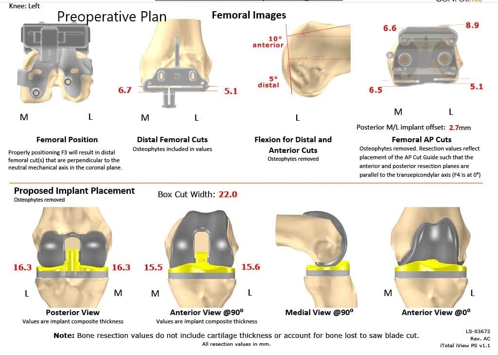 Plan quirúrgico completo específico para pacientes de Ortopedia para un reemplazo personalizado de rodilla izquierda en un hombre de 40 años - escaneo 2