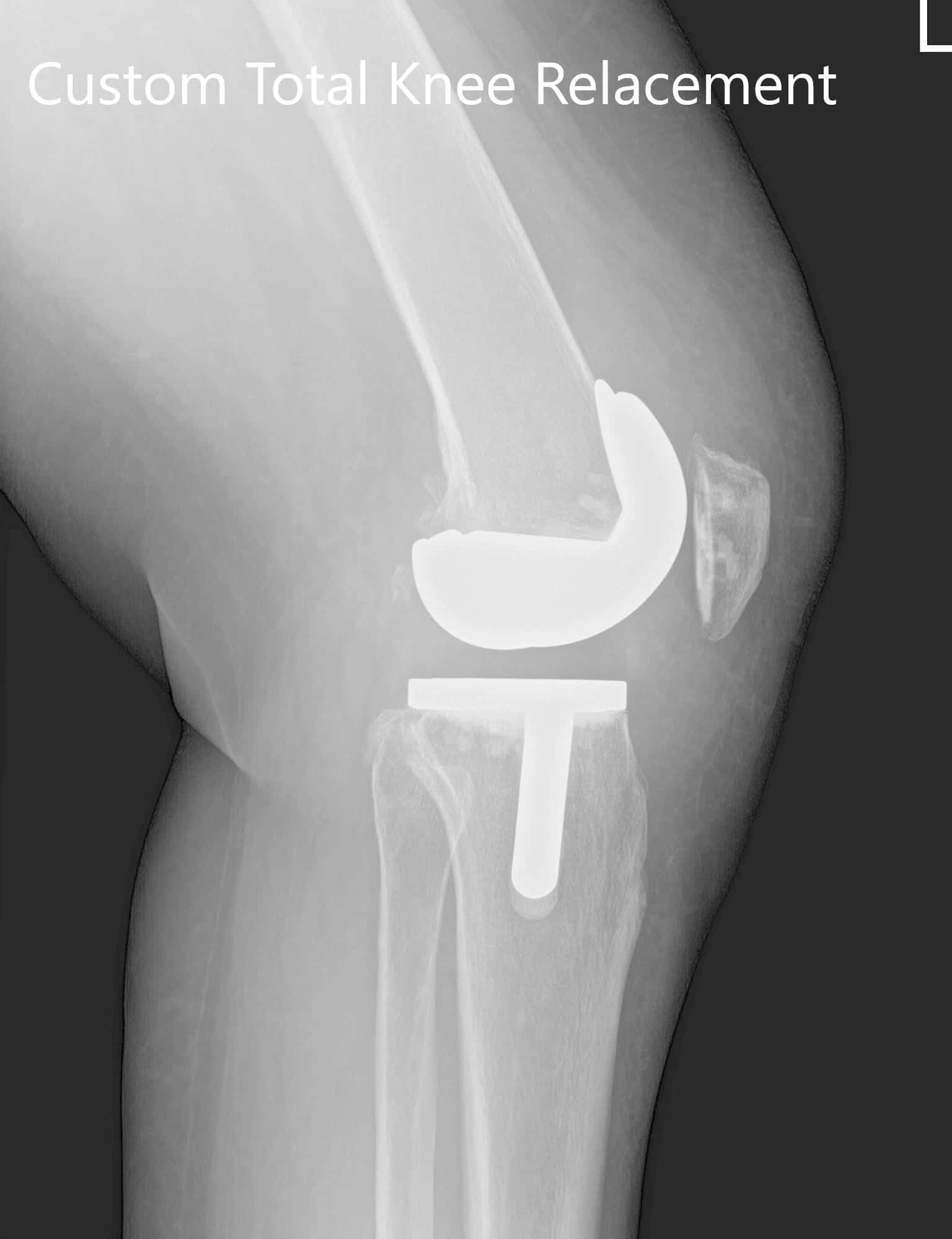 Tres meses de radiografía postoperatoria de la rodilla izquierda que mostró imágenes AP e laterales