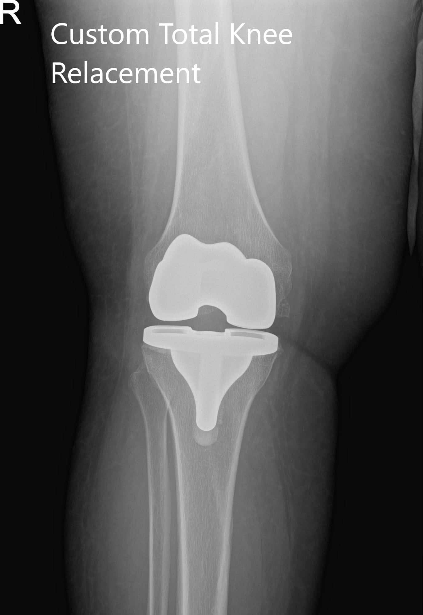 Radiografía postoperatoria de la rodilla derecha del paciente mostrando visión AP y lateral