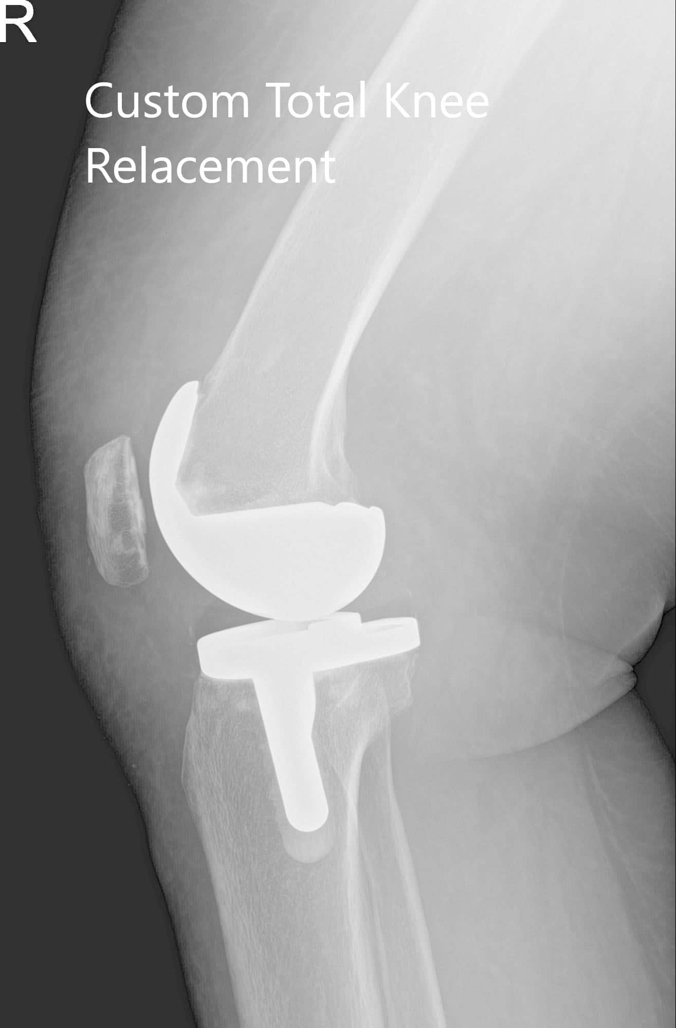 Radiografía postoperatoria de la rodilla derecha del paciente mostrando visión AP y lateral - img 2