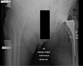 Radiografía postoperatoria que muestra vista AP de la pelvis en ambas caderas, cadera izquierda con alambres de cerclaje y espaciador antibiótico in situ