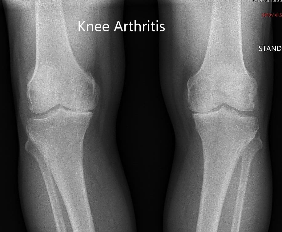 Radiografía preoperatoria que muestra la vista de las dos articulaciones de la rodilla Radiografía preoperatoria que muestra la vista de las dos articulaciones de la rodilla