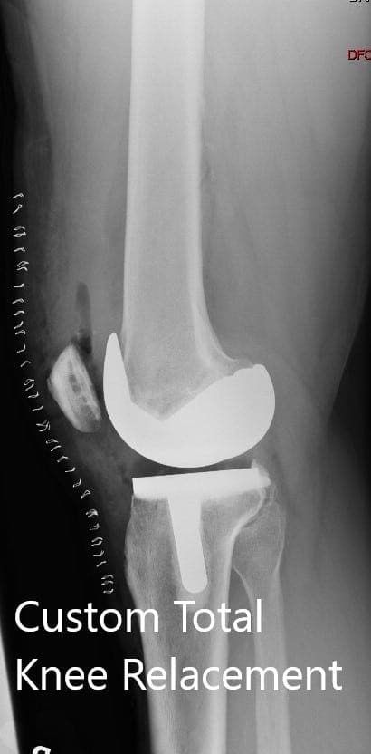 Radiografía postoperatoria que muestra la vista lateral de la rodilla derecha e izquierda Radiografía postoperatoria que muestra la vista lateral de la rodilla derecha e izquierda