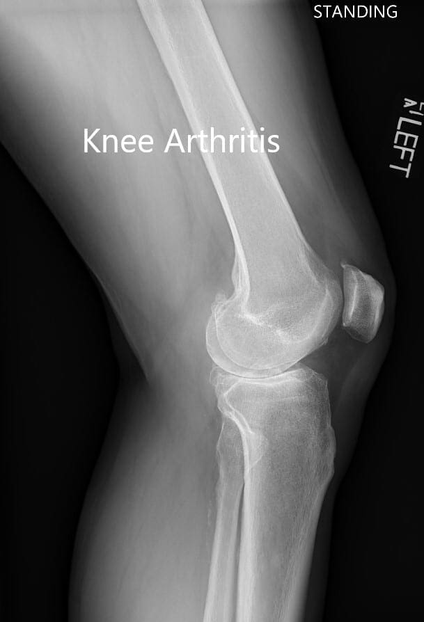 Radiografía preoperatoria que muestra la vista lateral de la articulación de la rodilla izquierda y derecha Radiografía preoperatoria que muestra la vista lateral de la articulación de la rodilla izquierda y derecha
