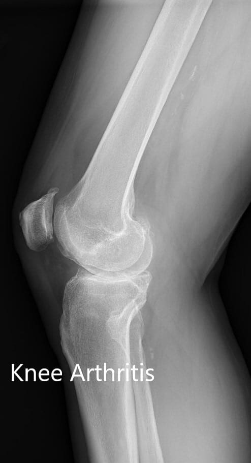 Radiografía preoperatoria que muestra la vista lateral de la articulación de la rodilla izquierda y derecha - img 2 Radiografía preoperatoria que muestra la vista lateral de la articulación de la rodilla izquierda y derecha - img 2