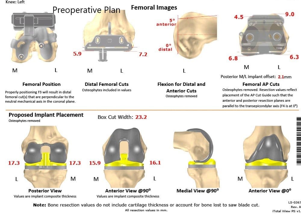Plan quirúrgico completo específico para pacientes en ortopedia para un reemplazo bilateral personalizado de rodilla total en una mujer de 72 años - escaneo 2