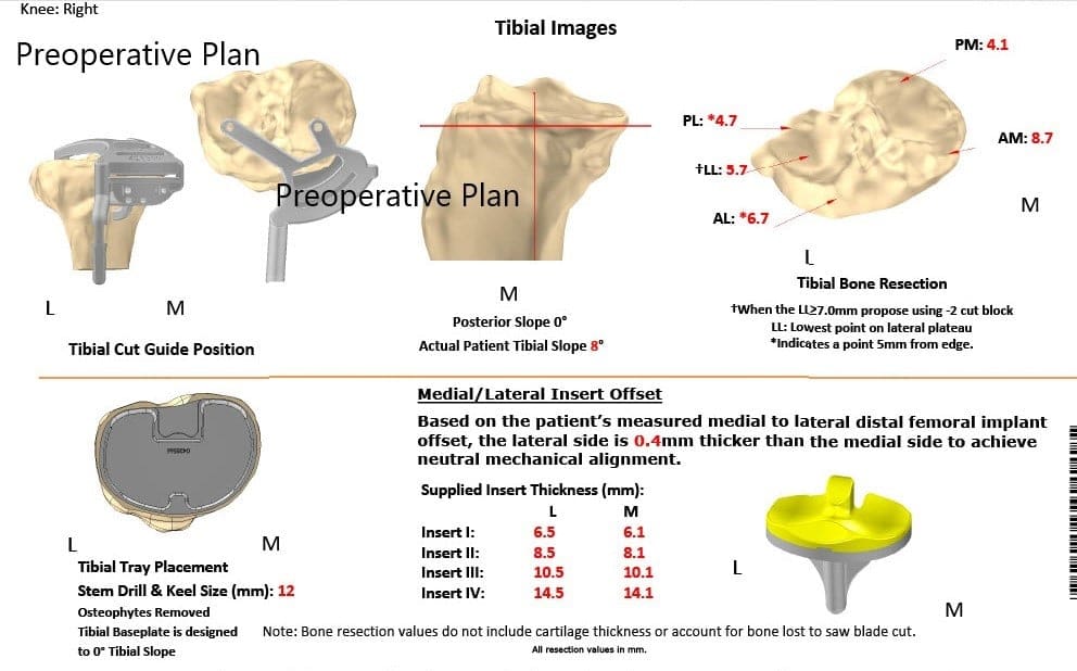 Plan quirúrgico completo específico para pacientes en ortopedia para un reemplazo bilateral personalizado de rodilla total en una mujer de 72 años - ecografía 3