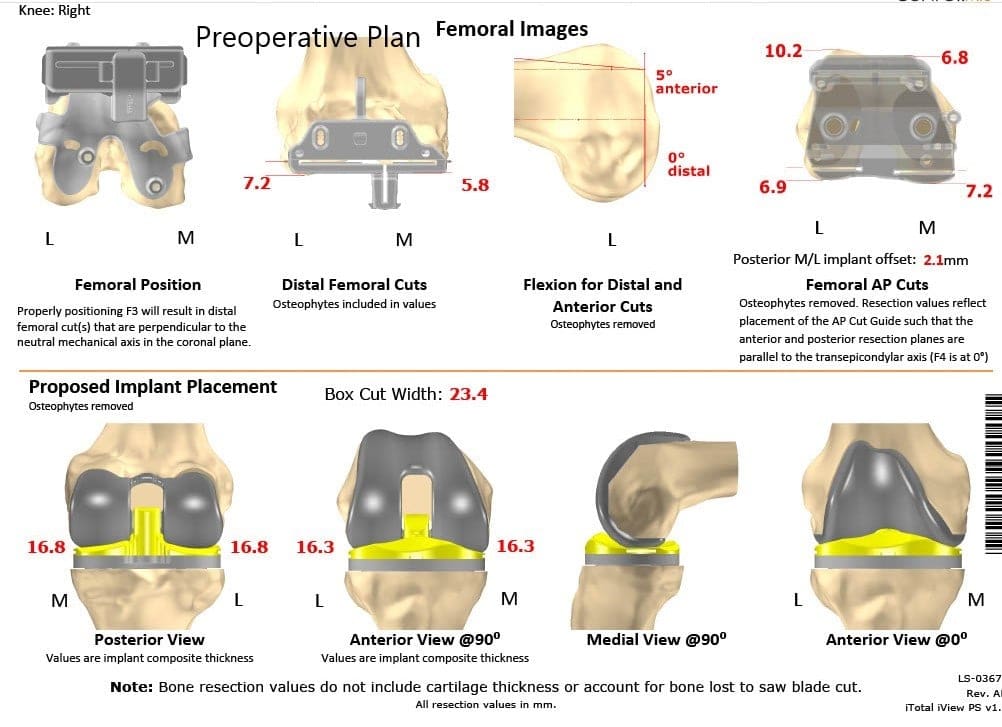 Plan quirúrgico completo específico para paciente en ortopedia para un reemplazo bilateral personalizado de rodilla total en una mujer de 72 años - ecografía 4