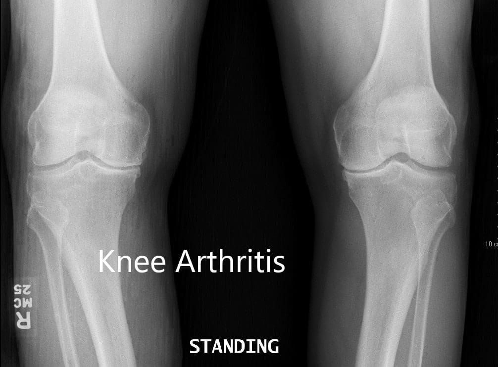 Radiografía preoperatoria que muestra la vista AP de ambas rodillas Radiografía preoperatoria que muestra la vista AP de ambas rodillas