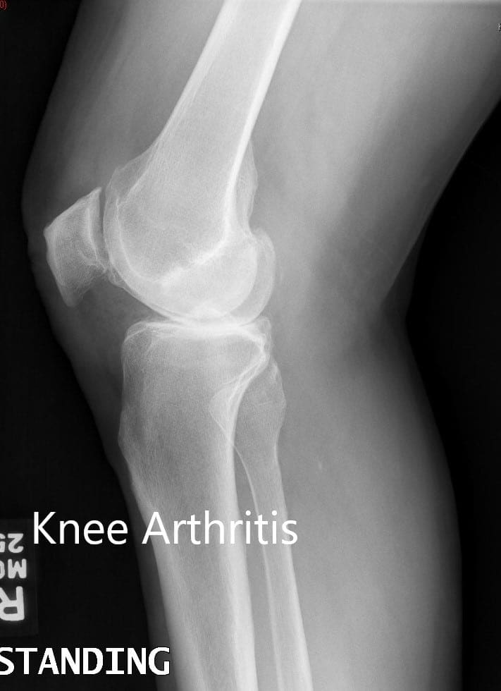 Radiografía preoperatoria que muestra las vistas laterales de la rodilla derecha e izquierda respectivamente Radiografía preoperatoria que muestra las vistas laterales de la rodilla derecha e izquierda respectivamente
