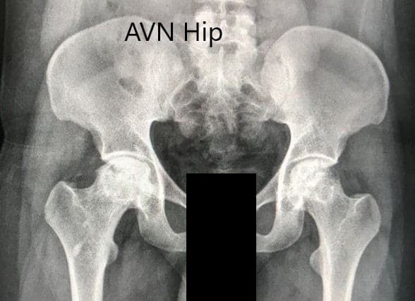 Radiografía preoperatoria de la pelvis con ambas caderas en vista anteroposterior que muestra el AVN de ambas caderas