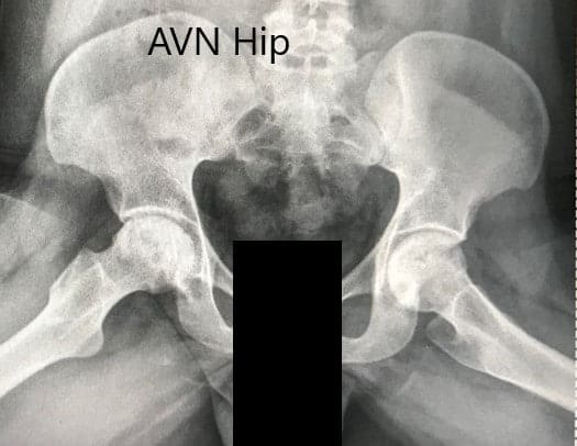 Radiografía preoperatoria de la pelvis con ambas caderas en la vista lateral con patas de rana mostrando la NVA de ambas caderas