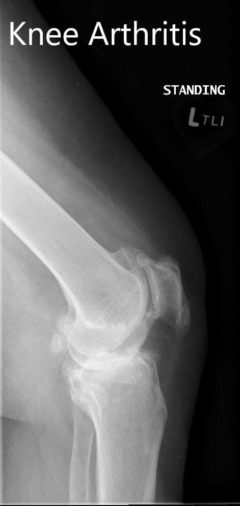 Preoperative X-ray showing the lateral and the AP views Preoperative X-ray showing the lateral and the AP views