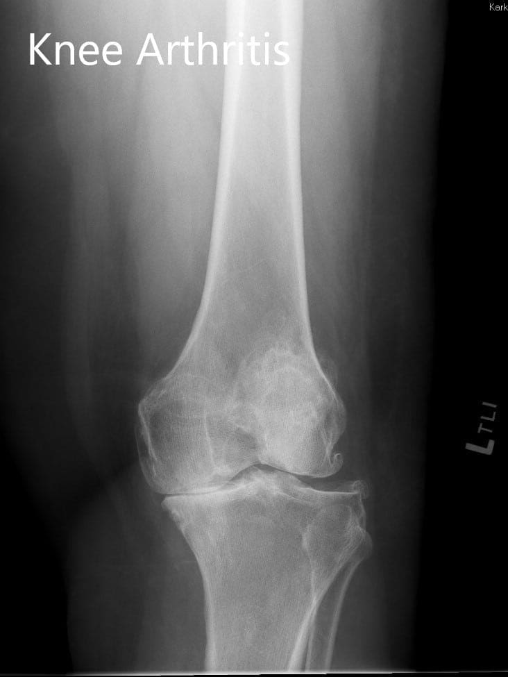 Preoperative X-ray showing the lateral and the AP views - img 2 Preoperative X-ray showing the lateral and the AP views - img 2