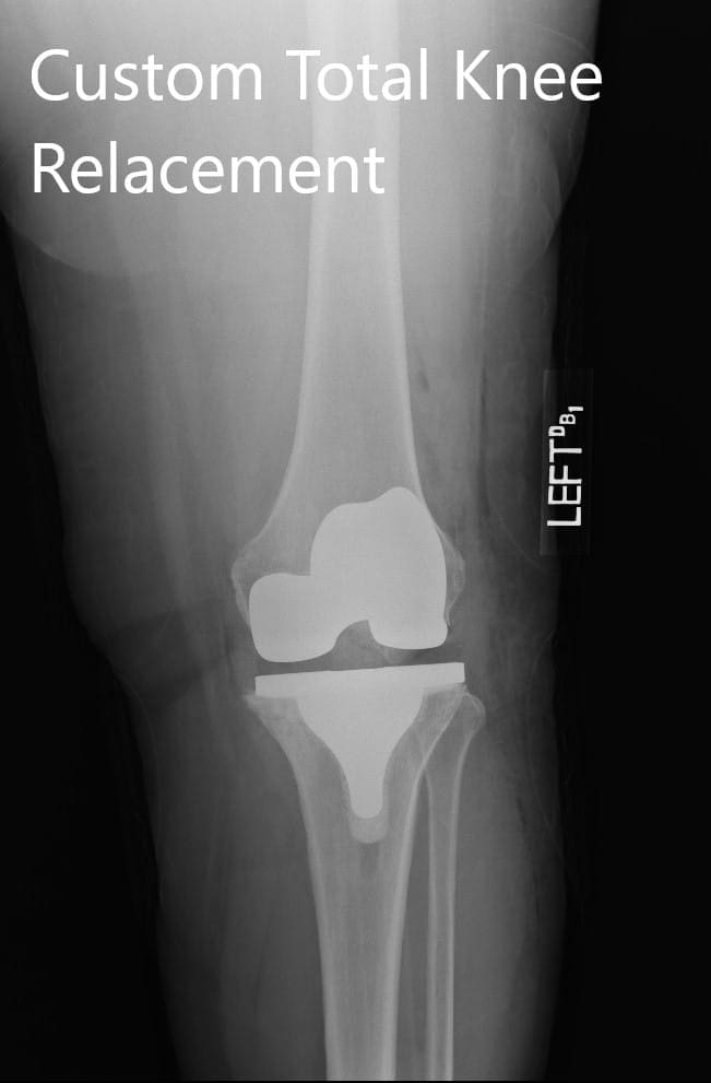 Postoperative X-ray images showing the AP and lateral views of the left knee Postoperative X-ray images showing the AP and lateral views of the left knee
