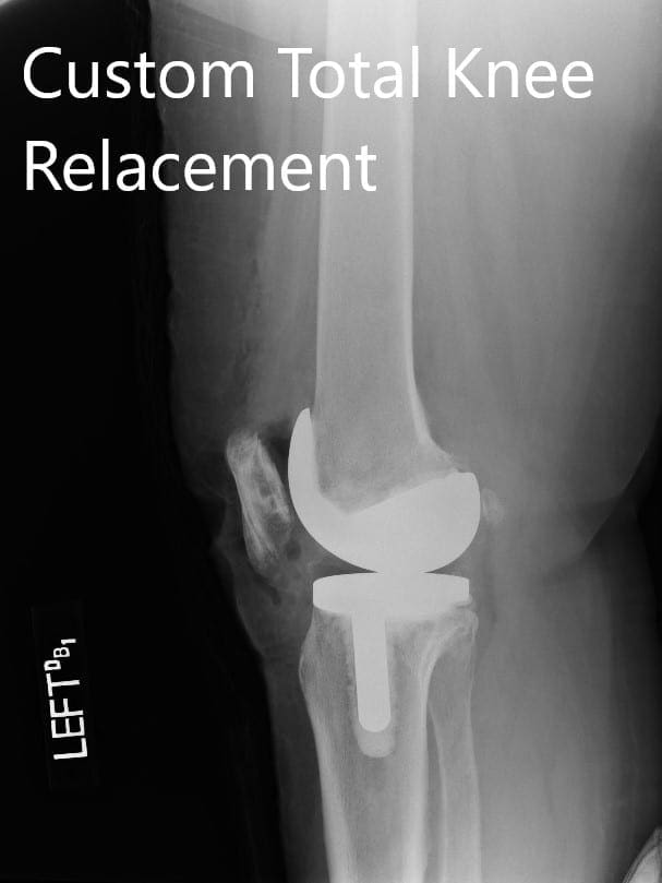 Postoperative X-ray images showing the AP and lateral views of the left knee - img 2 Postoperative X-ray images showing the AP and lateral views of the left knee - img 2