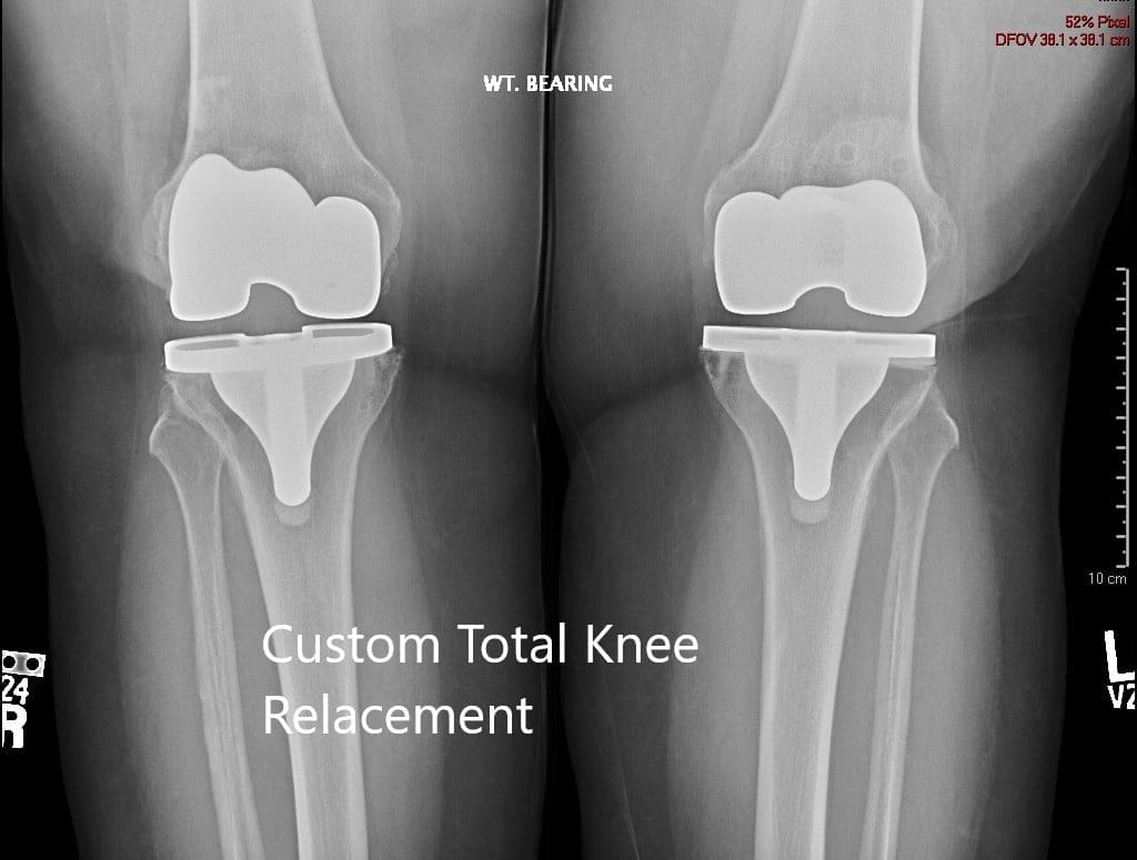 Postoperative X-ray showing the AP view of both knees
