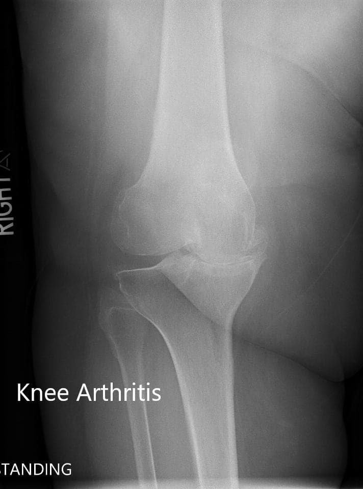 Radiografía preoperatoria de la rodilla derecha que mostró vistas AP y laterales Radiografía preoperatoria de la rodilla derecha que mostró vistas AP y laterales