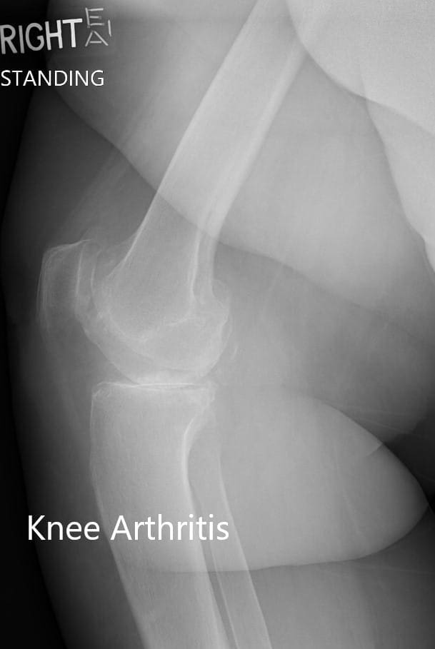 Radiografía preoperatoria de la rodilla derecha mostrando visión AP y lateral - IMG 2 Radiografía preoperatoria de la rodilla derecha mostrando visión AP y lateral - IMG 2