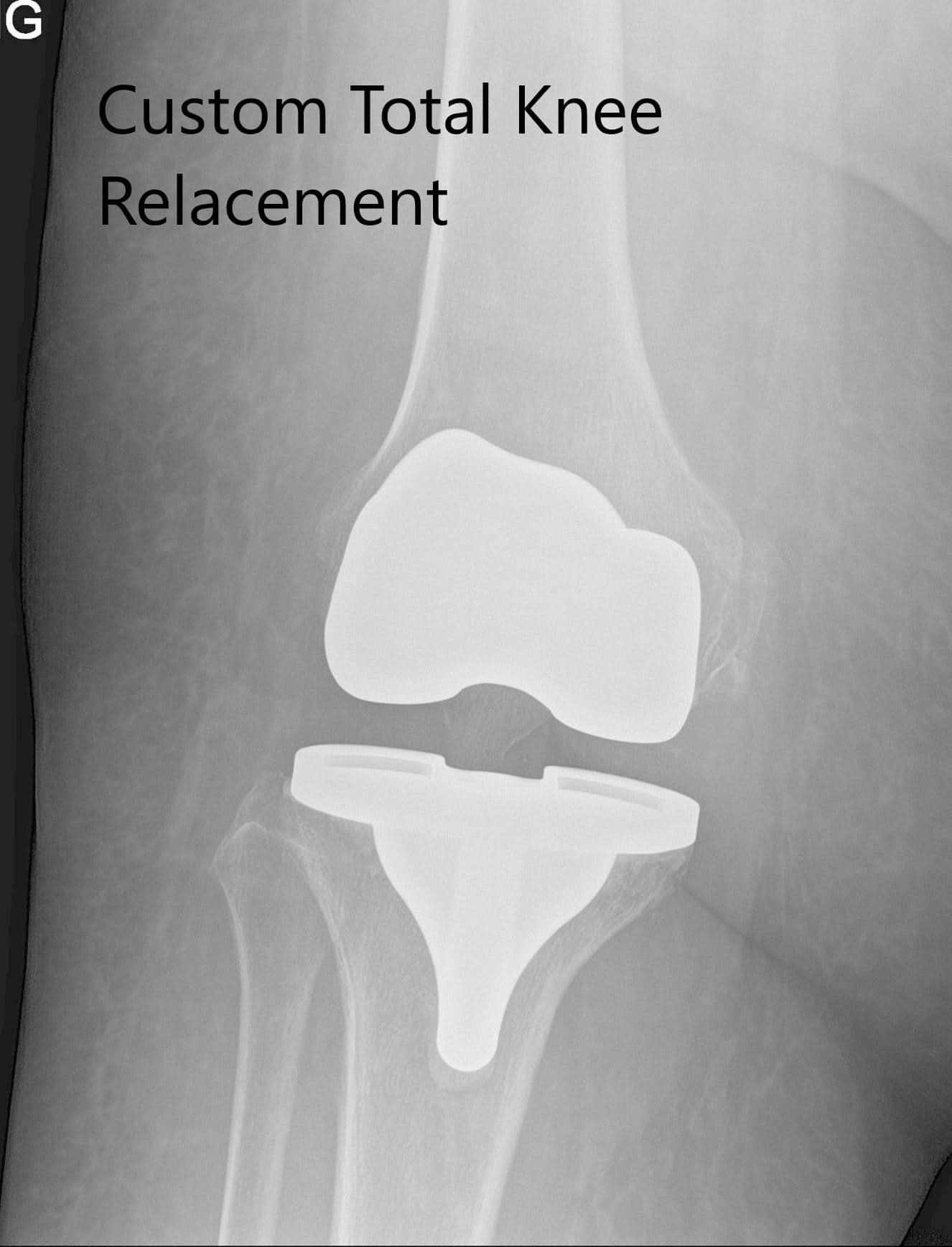 Imágenes de radiografía postoperatorias que muestran la AP y las vistas laterales de la rodilla derecha Imágenes de radiografía postoperatorias que muestran la AP y las vistas laterales de la rodilla derecha