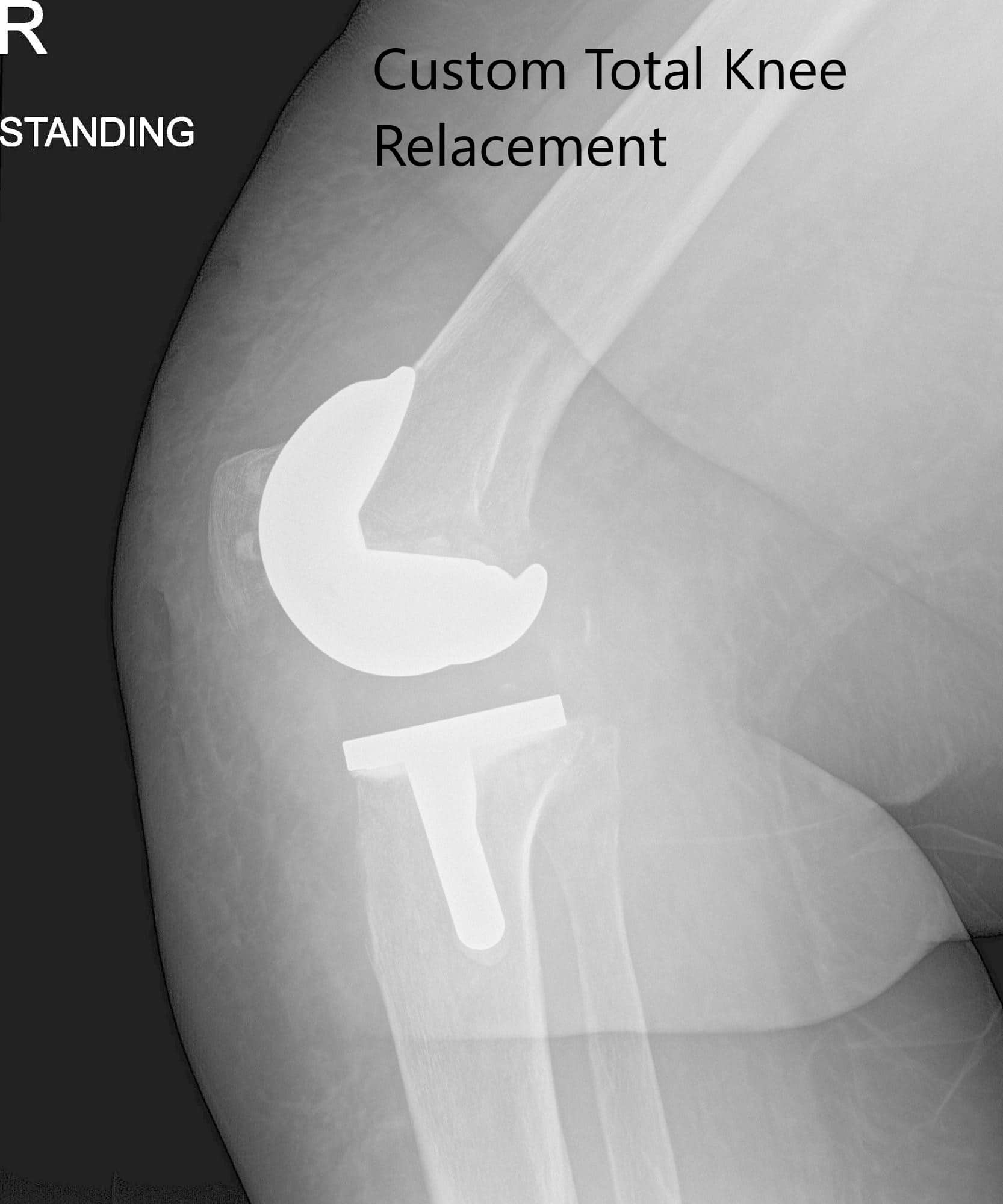 Imágenes de radiografías postoperatorias que muestran vistas AP y laterales de la rodilla derecha - IMG 2 Imágenes de radiografías postoperatorias que muestran vistas AP y laterales de la rodilla derecha - IMG 2