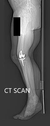 Imágenes de tomografía computarizada preoperatoria de las extremidades inferiores - img 2